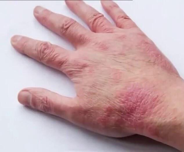 Роздратування шкіри рук
