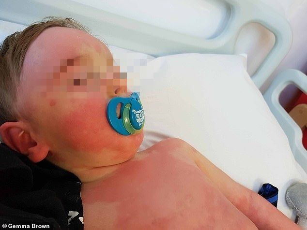 Ребенок попал в больницу со страшной сыпью