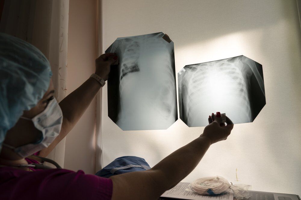 Результаты рентгенологического исследования легких 5-летней девочки в больнице в Черновцах