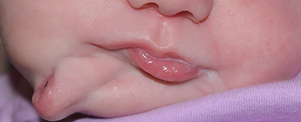 Младенец с двумя ртами