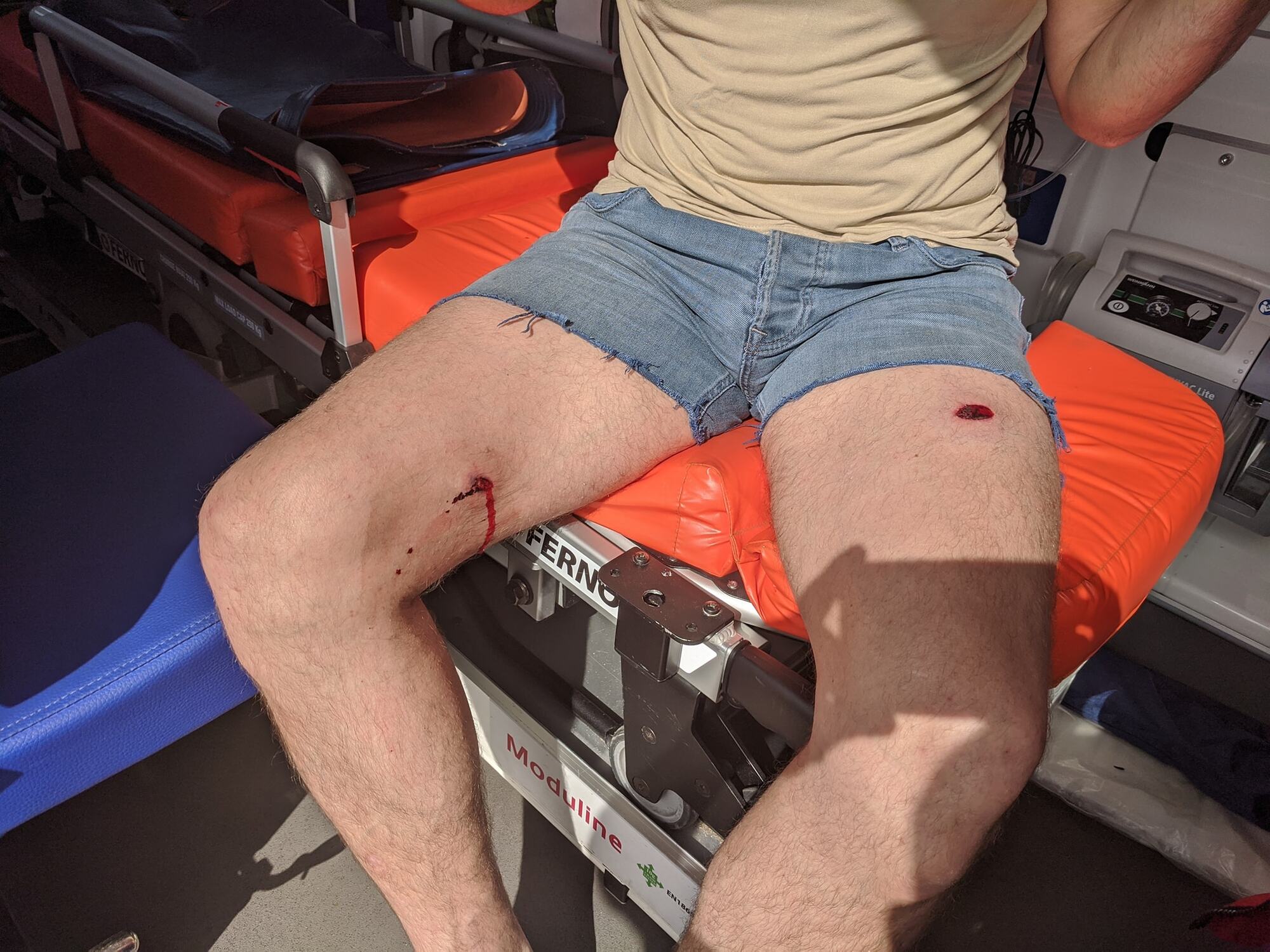 На Київщині депутату в бійці прострелили ногу