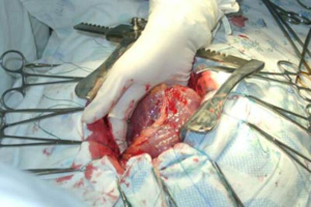 В Іспанії у живого українця вирізали нирки і серце