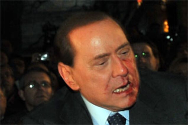 Берлусконі належить лікуватися не один тиждень (ФОТО)