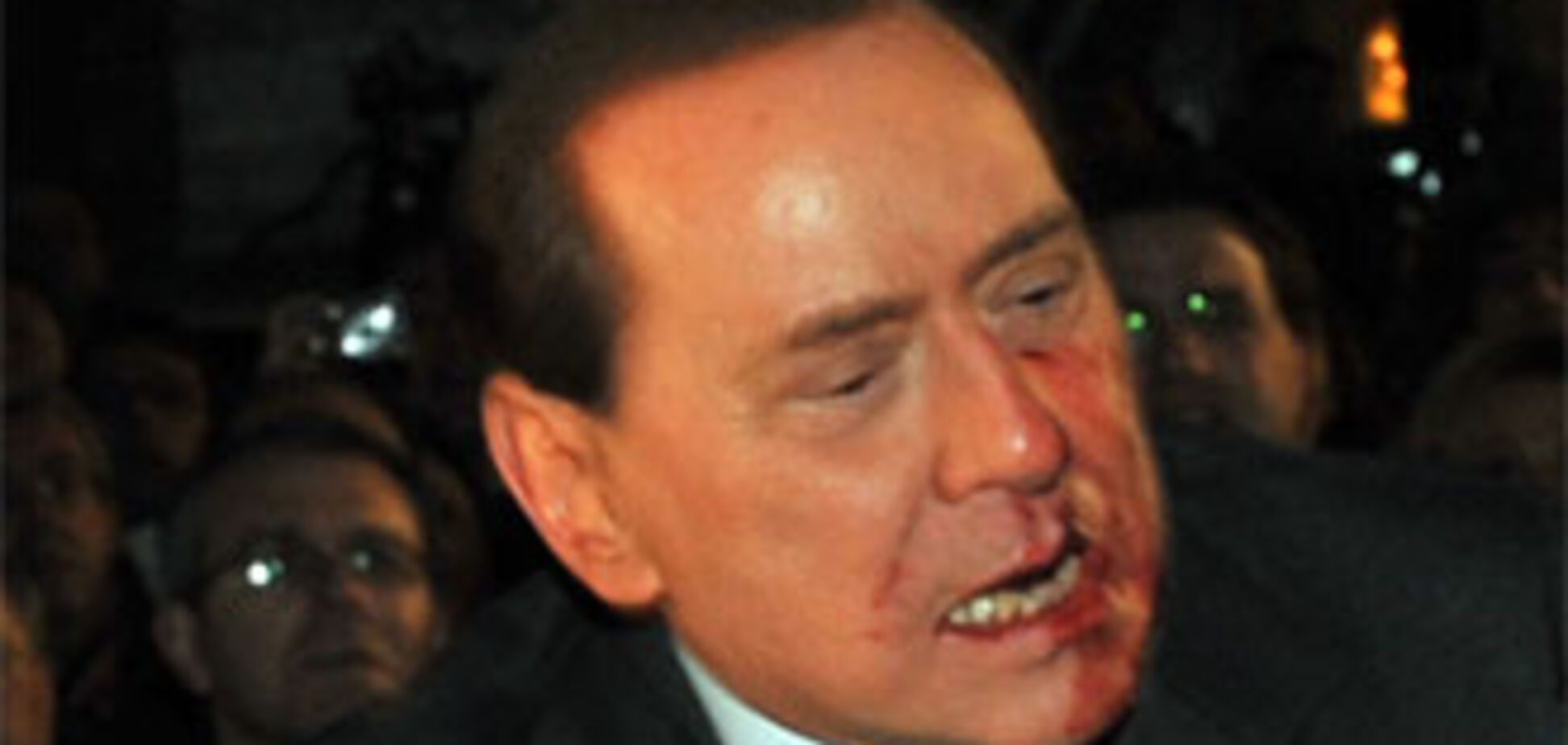 Берлусконі належить лікуватися не один тиждень (ФОТО)