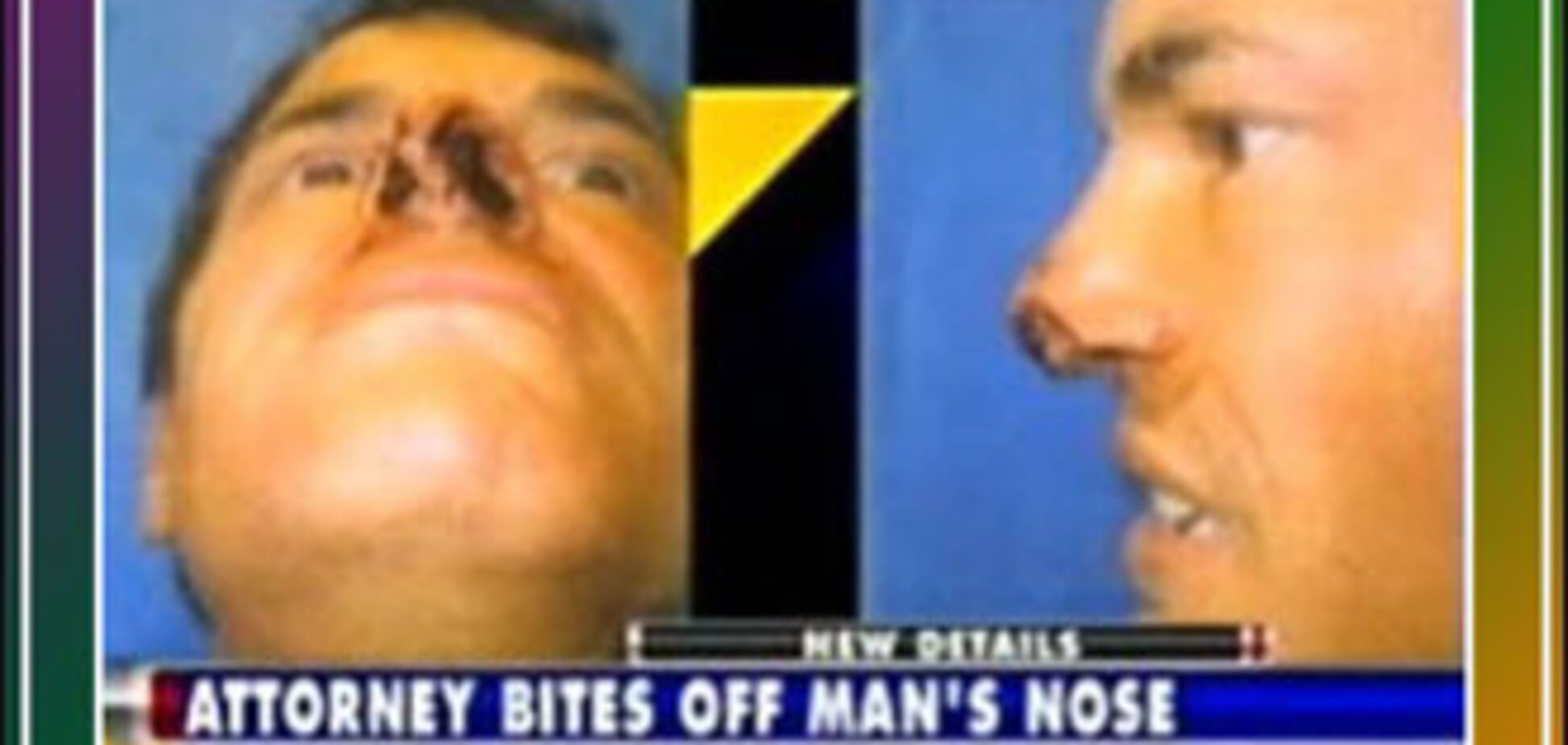 Адвокат откусил нос сопернику в борьбе за место в туалете
