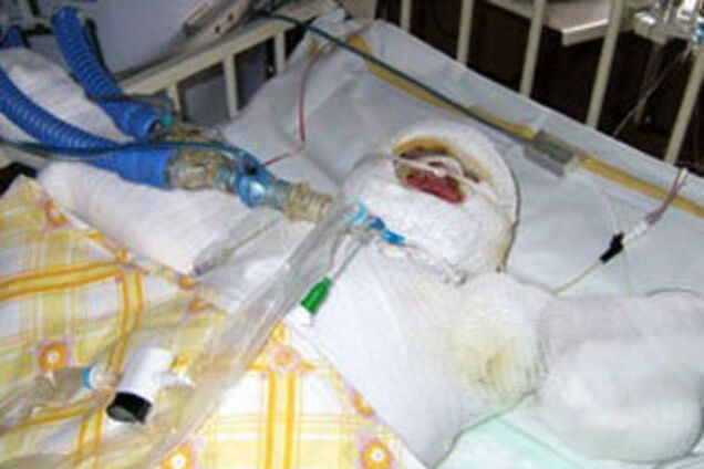 Европа болеет неонацизмом. В Чехии подожгли малышку-цыганку