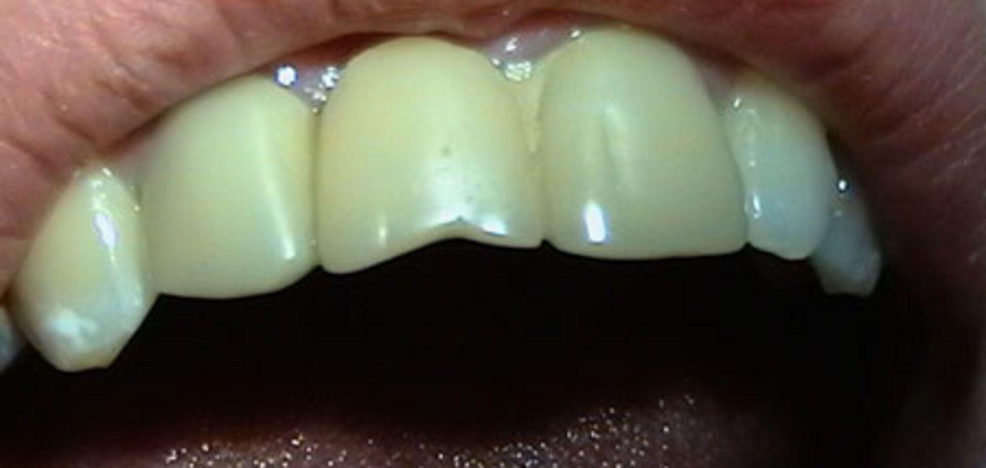 Газировка может оставить ребёнка без зубов