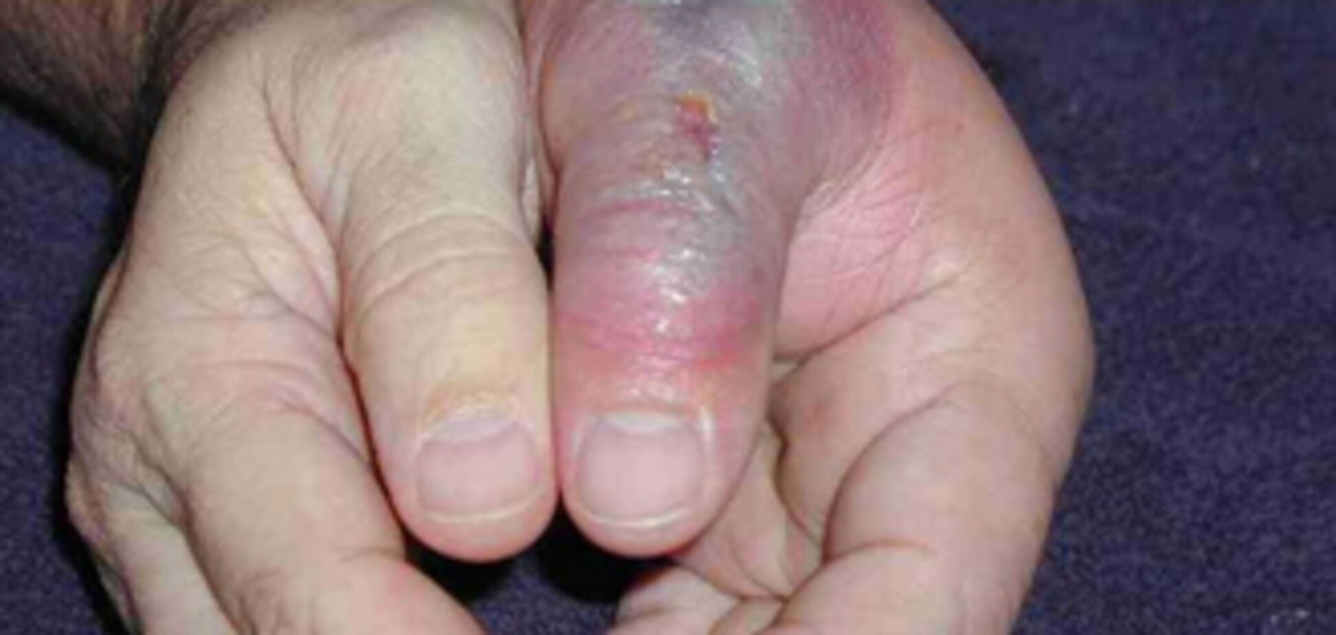 Павуки відправили до лікарні ще двох українців