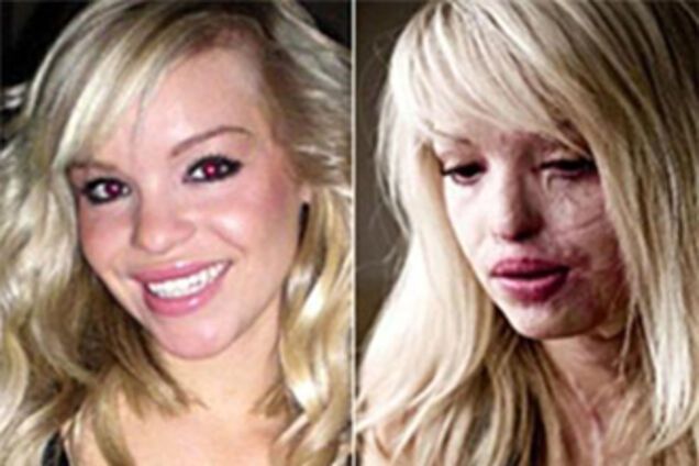 Изуродованная девушка снова будет работать моделью. ФОТО