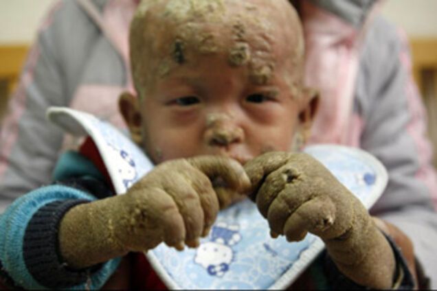 ' Хлопчик-риба' рятується у ванні з льодом