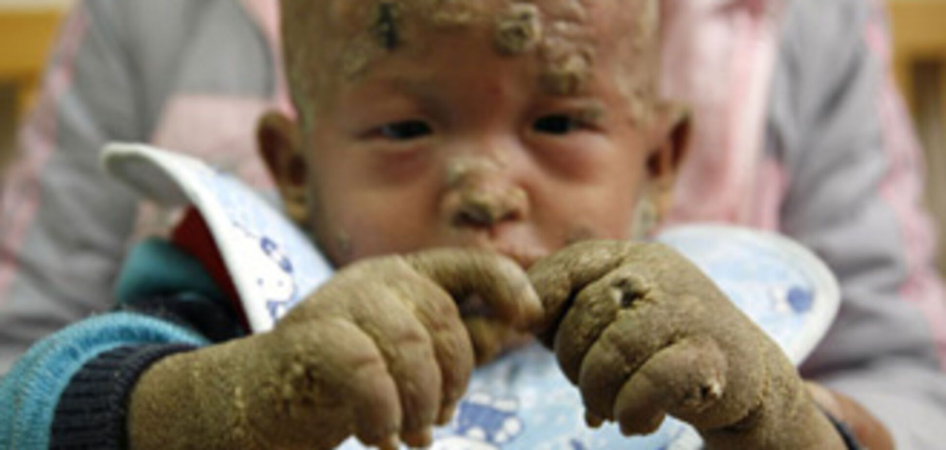 ' Хлопчик-риба' рятується у ванні з льодом