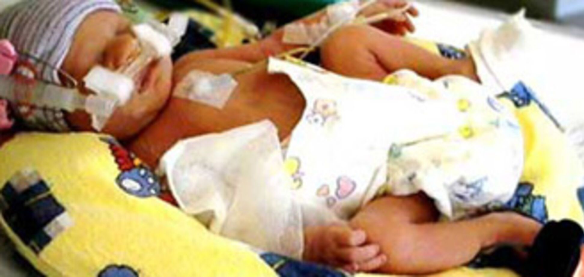Медики спасли 275-граммового младенца