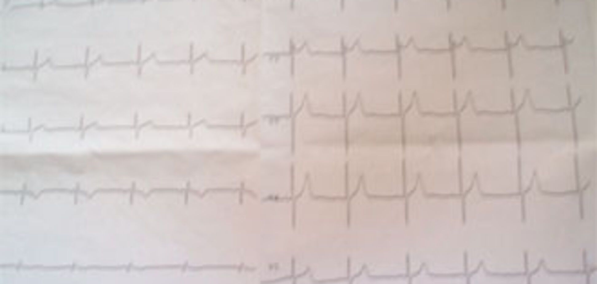 У сестри Парубія на грунті звинувачення розвинувся порок серця