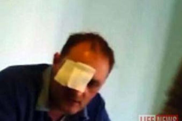 Зибров, потерявший глаз в драке, требует от обидчика $120000