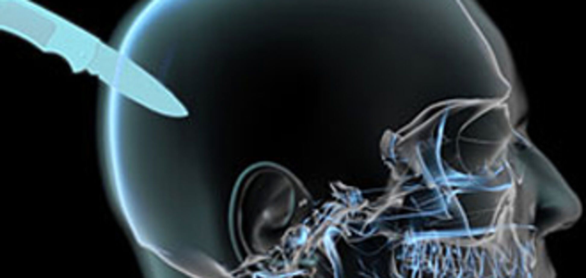 Мужчина три года проходил с ножом в голове