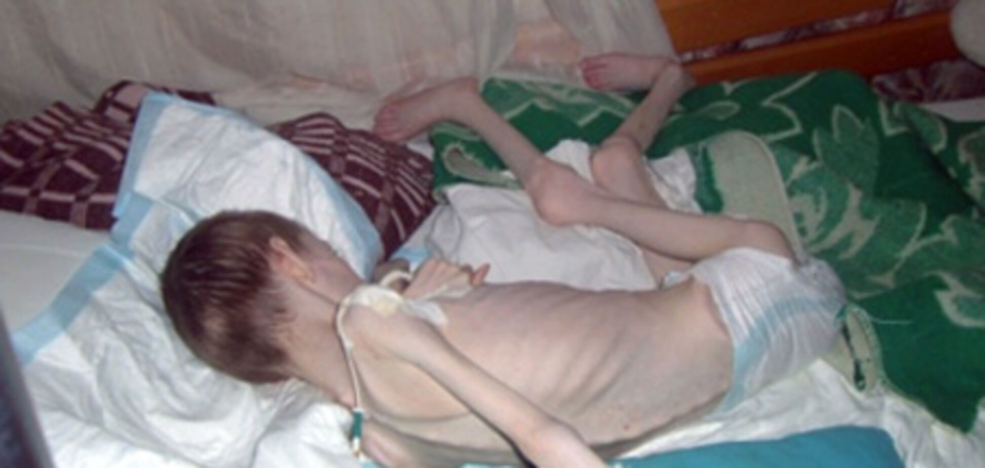 Шокирующие фото воспитанника российского интерната