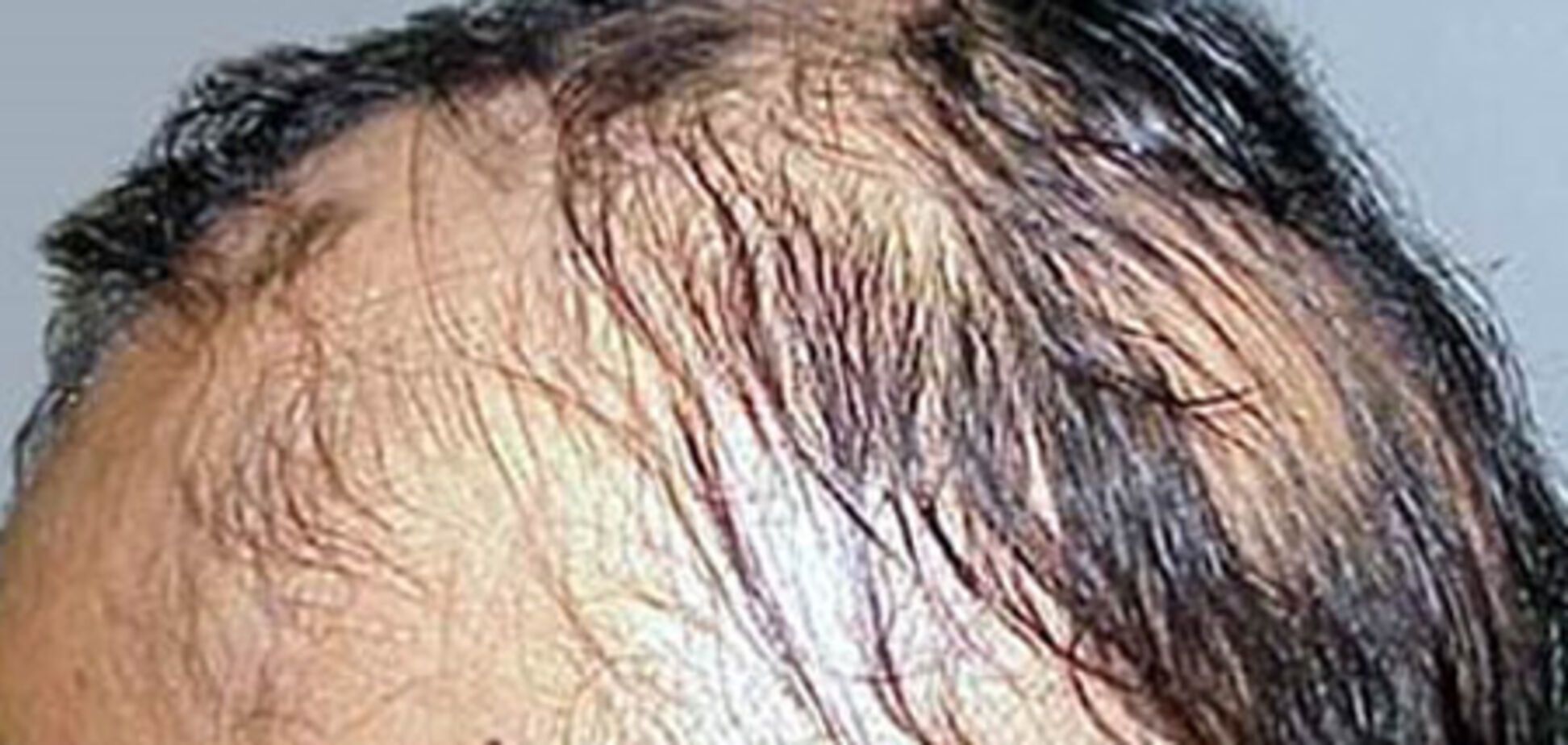 Названа головна причина чоловічого облисіння