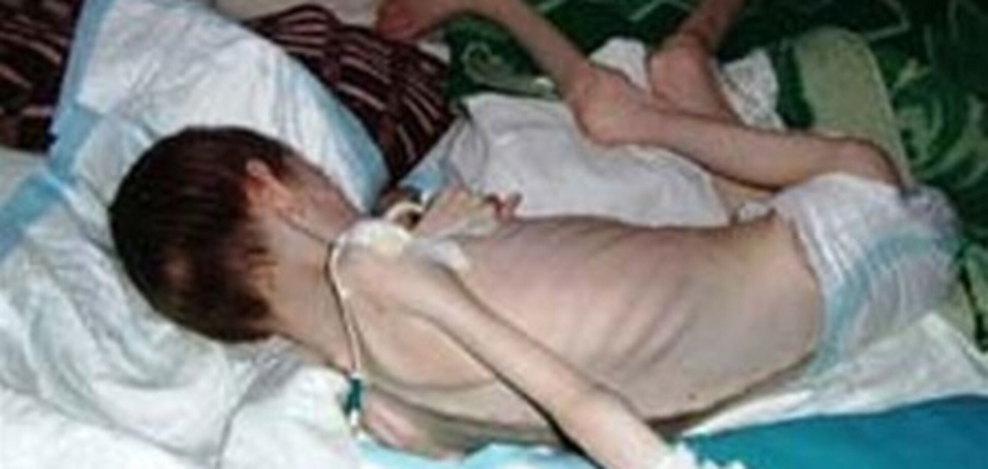 27 детей-инвалидов умерли от голода в интернате за 2 года