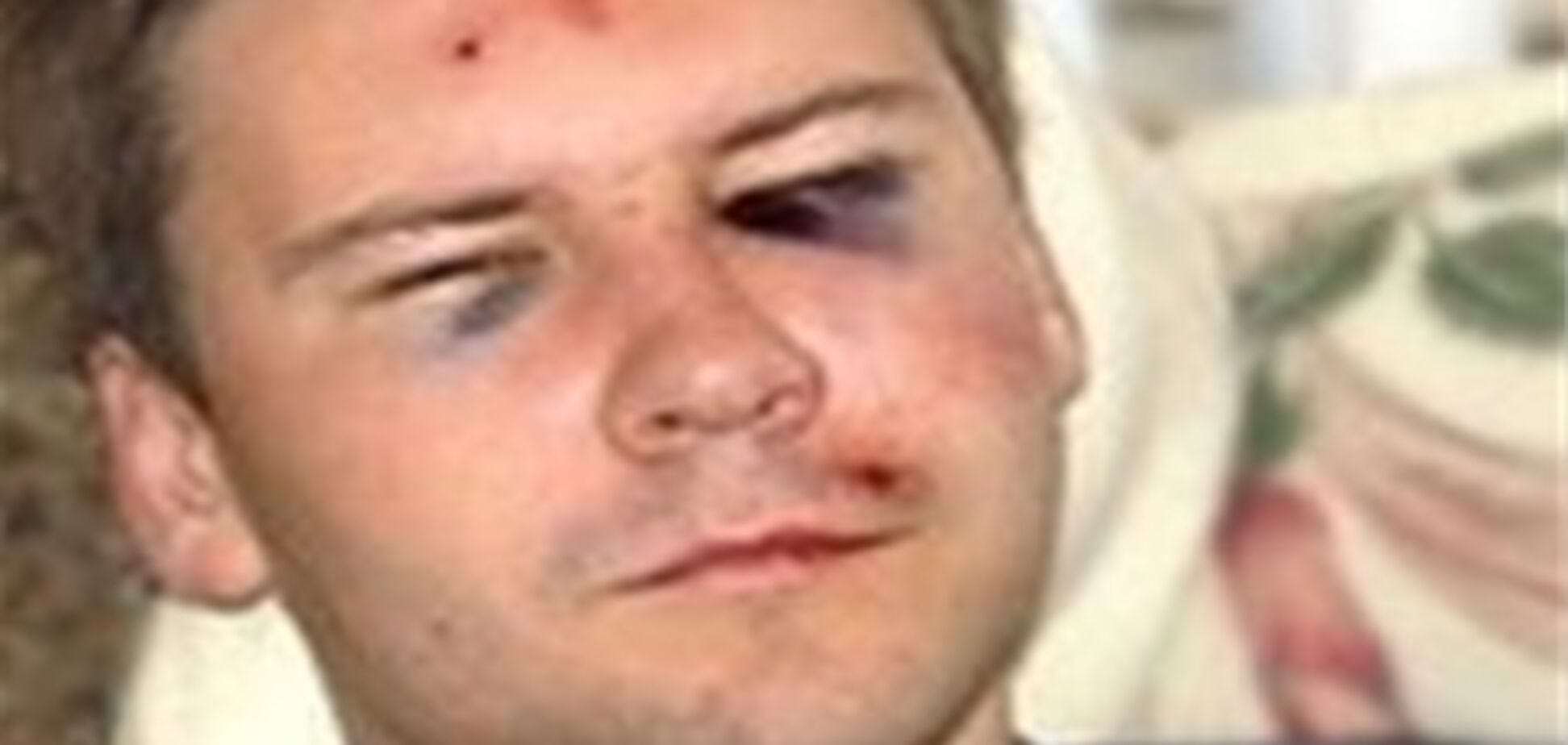 Миколаївському журналісту Влащенко доведеться жити з кулею в голові