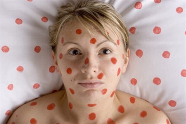 У наступному році Україну очікує епідемія кору - ВООЗ