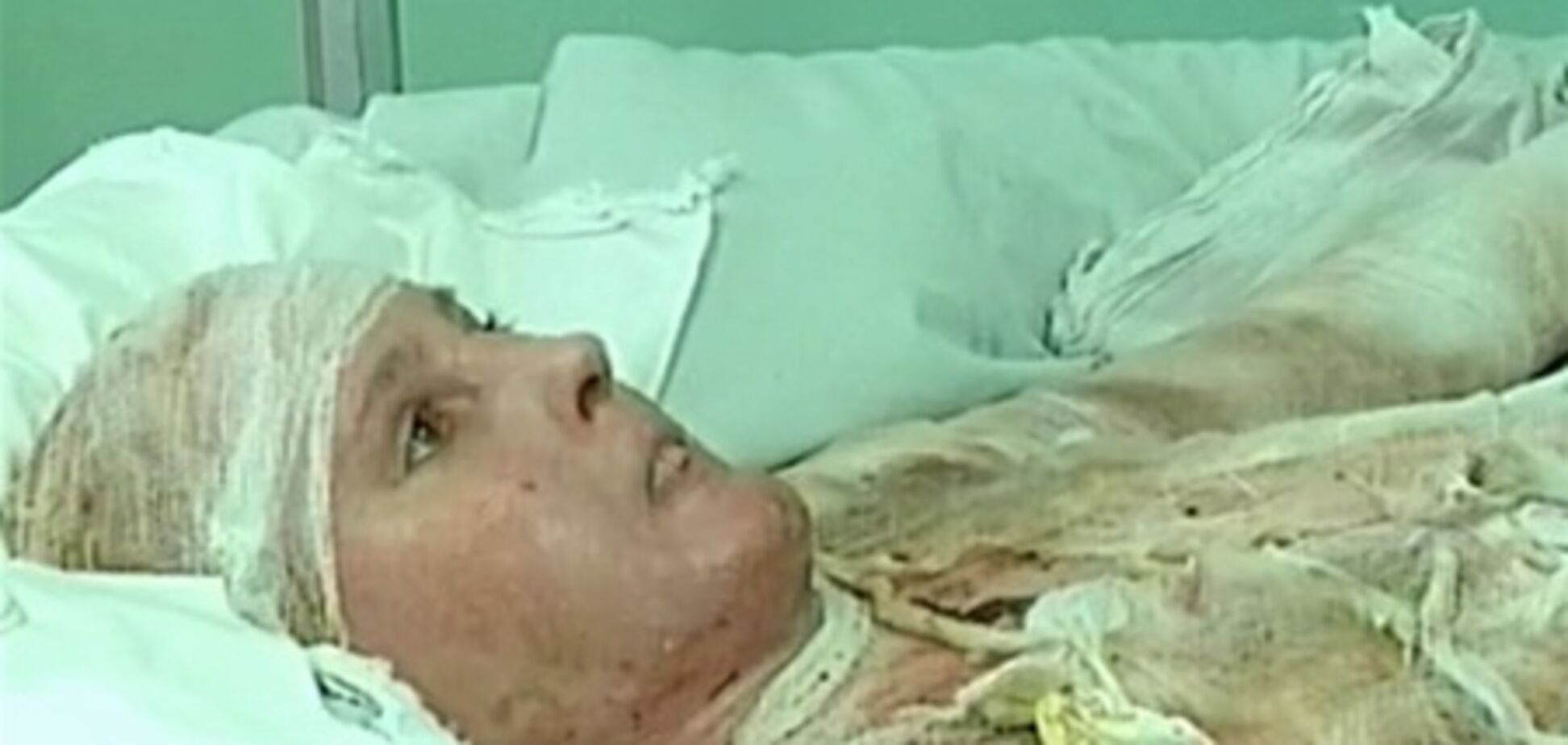 Вперше в Україні лікарі врятували жінку з 97% опіків тіла
