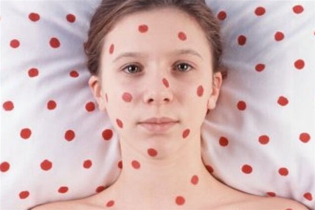 Львівщина. Одна людина вже померла від кору