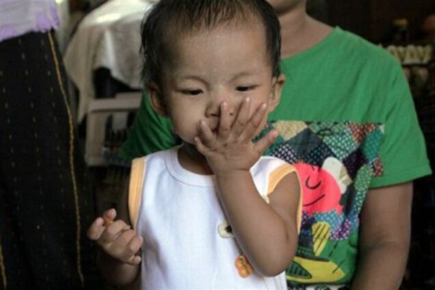 Маленька дівчинка живе з 26 пальцями