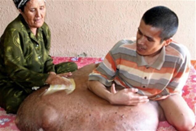 На нозі в'єтнамця виросла 80-кілограмова пухлина. ФОТО