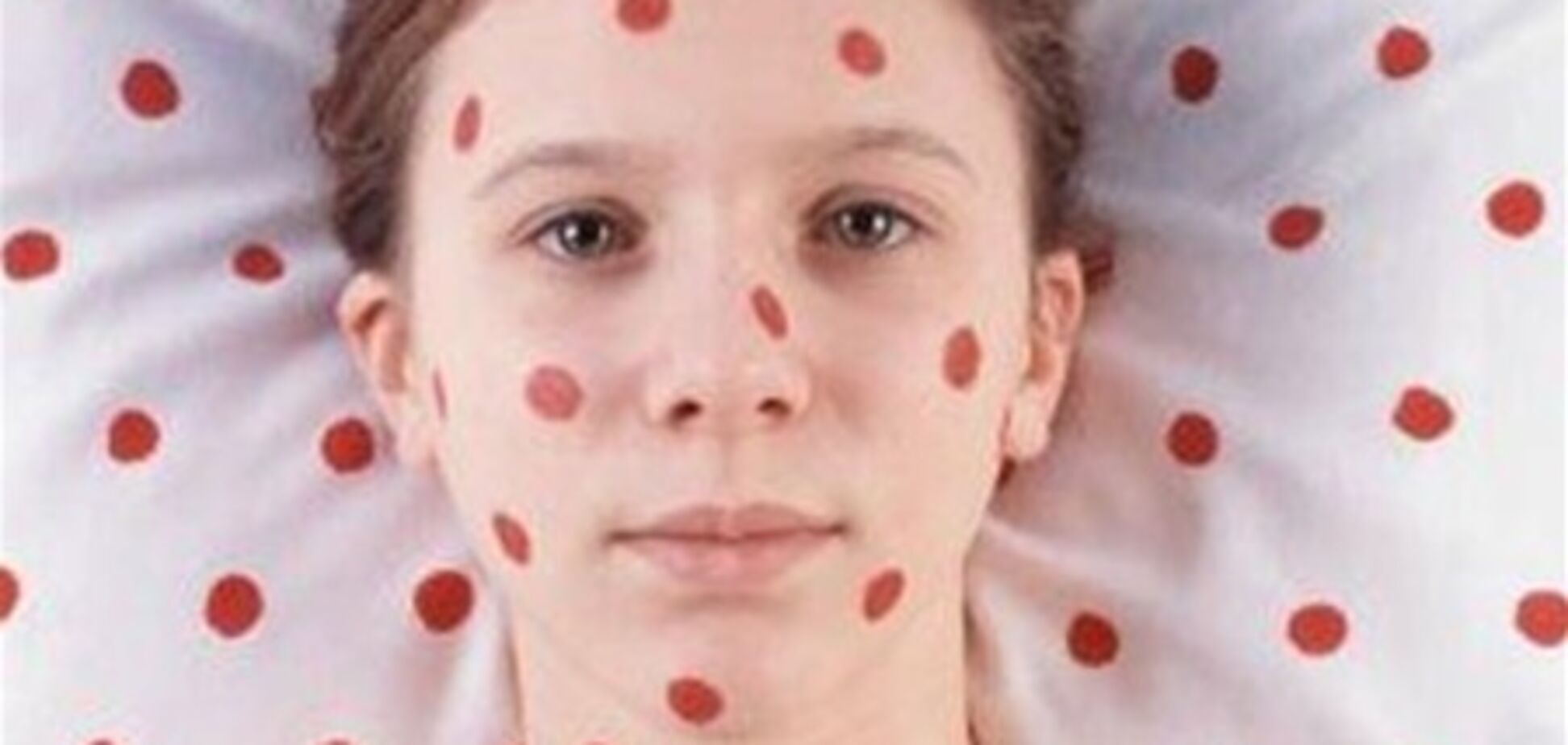 С начала 2012 года корью заболели почти 1000 украинцев