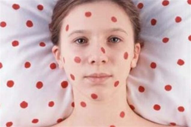 Кількість випадків захворювання на кір досягла 1,5 тисячі - МОЗ