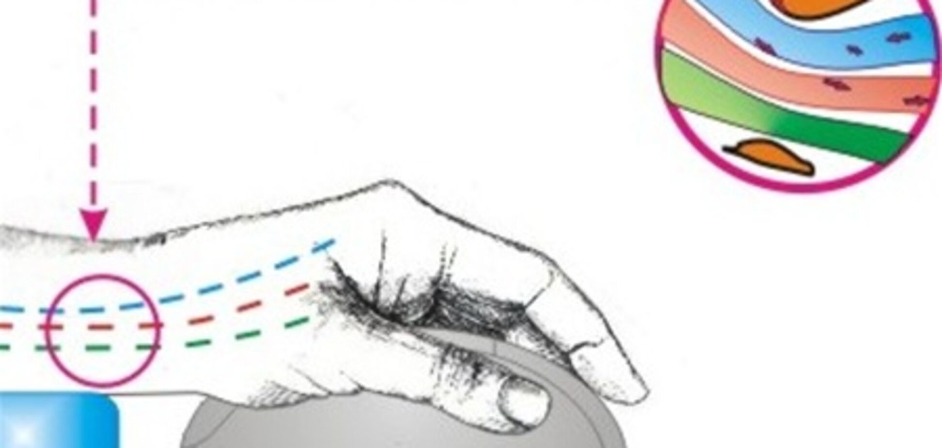 Как предупредить заболевание руки от компьютерной мышки