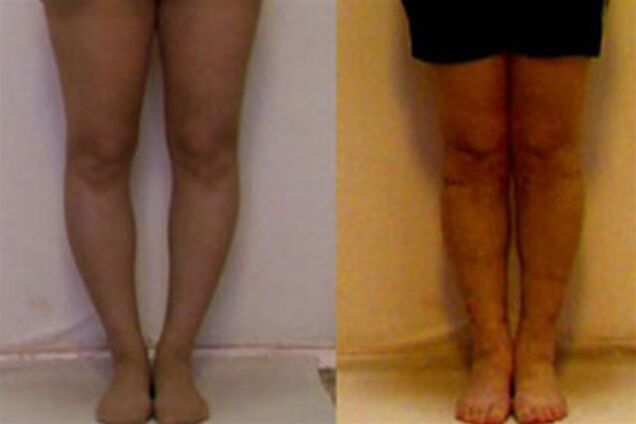 Как сделать ноги стройными и красивыми      