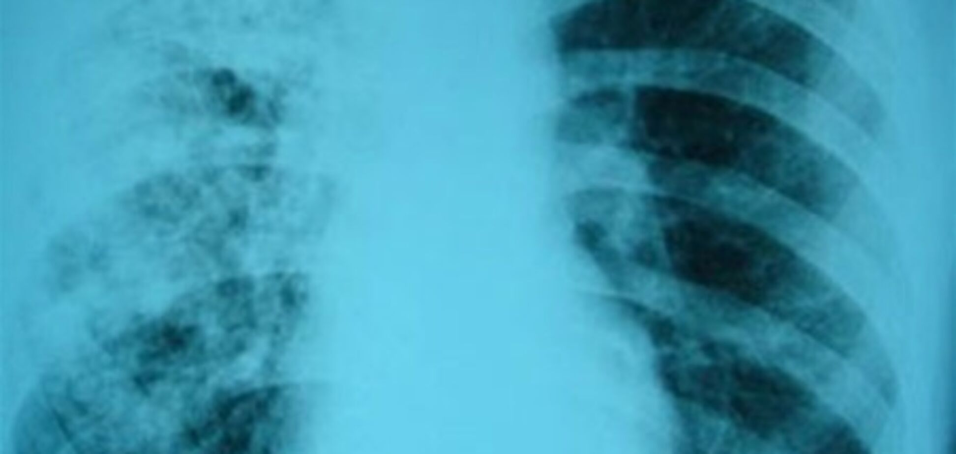 Як зупинити епідемію туберкульозу