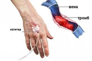 Тромбофлебит глубоких вен: симптомы и причины