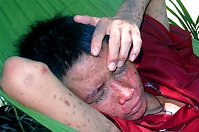 В'єтнам просить допомоги у боротьбі з таємничою хворобою