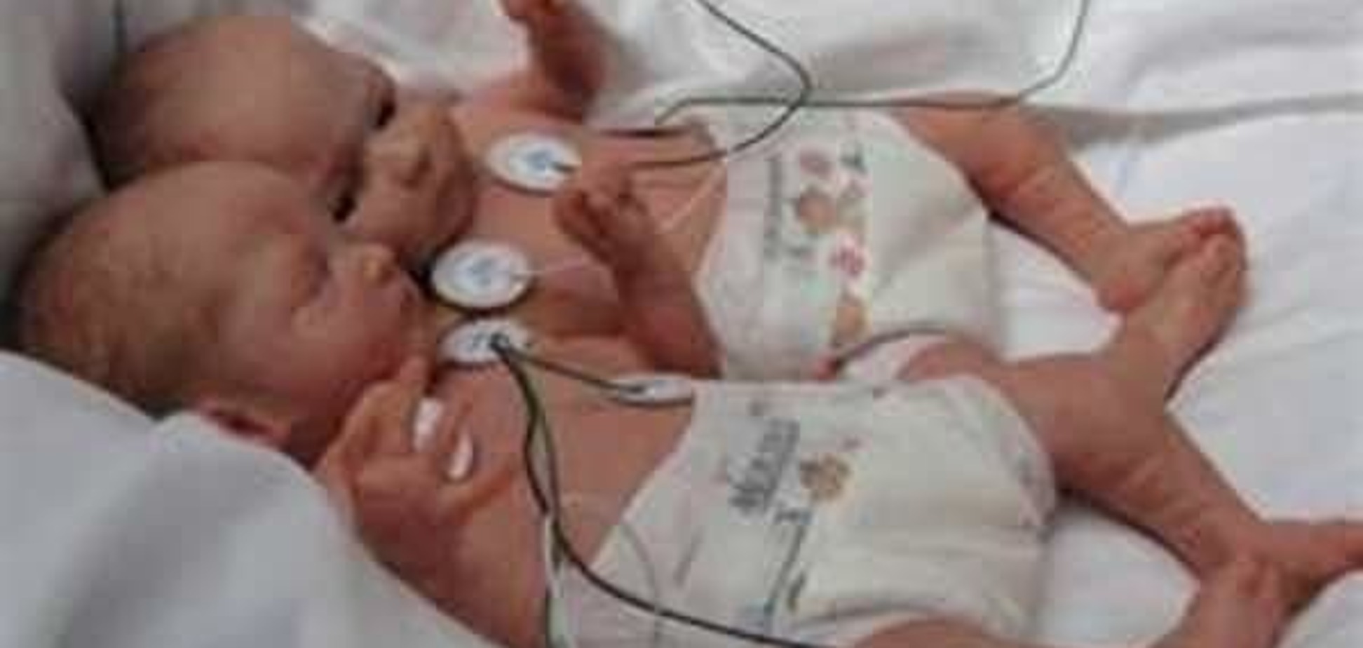 Искусственное оплодотворение может привести к рождению недоношенных близнецов