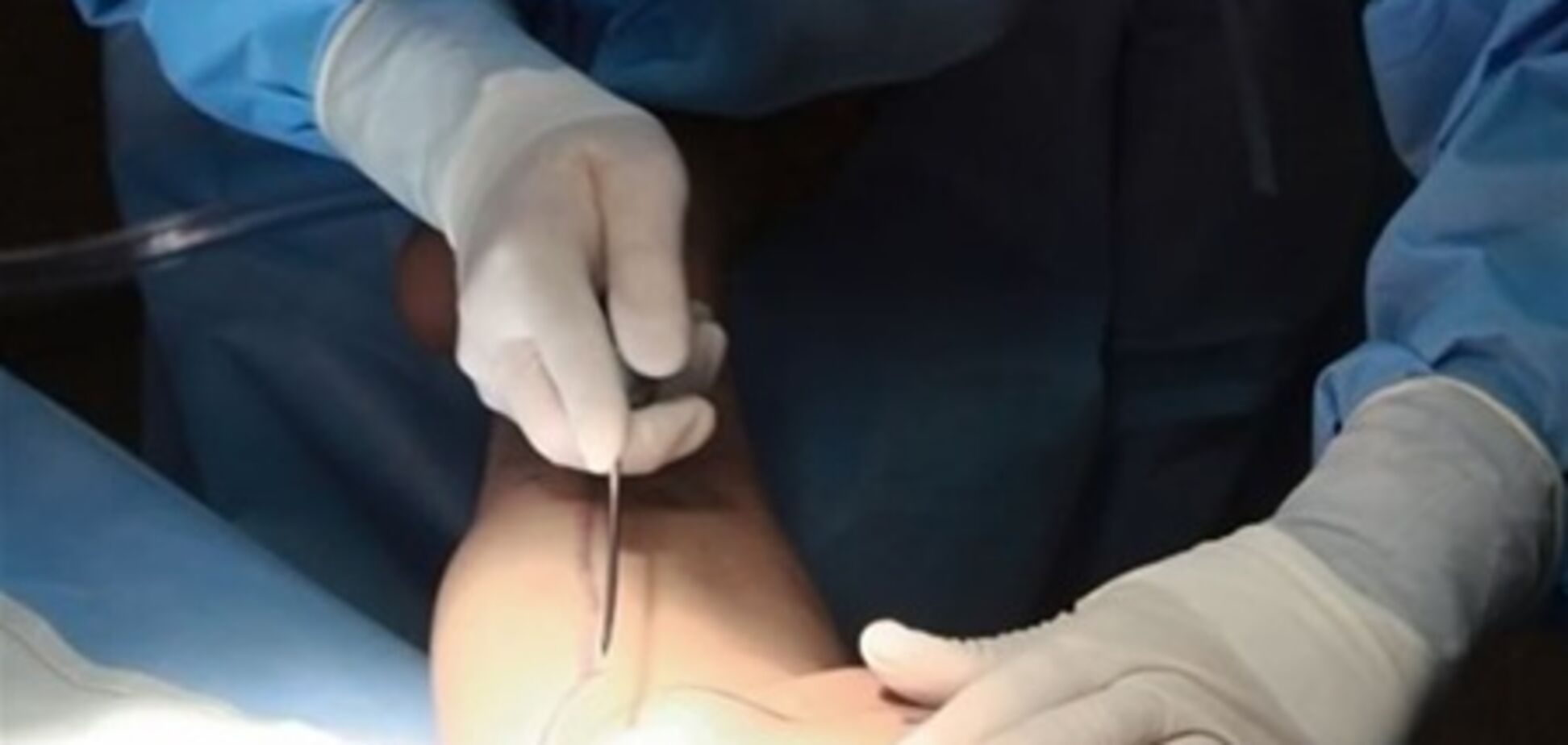 10 аргументов за и против липосакции