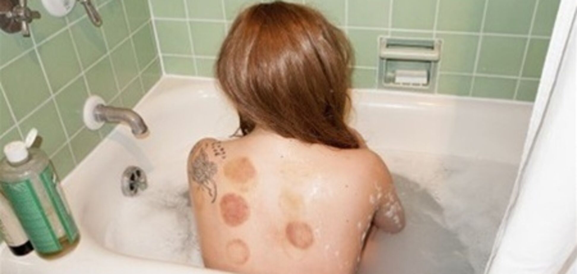 Гага показала синяки от банок Ричардсону. Фото