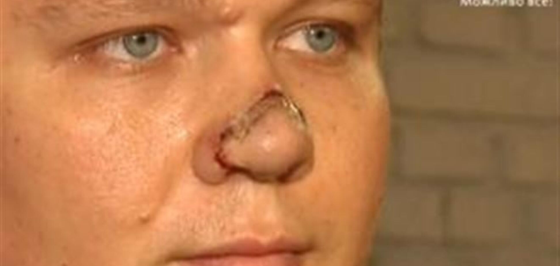 У Києві 'помічник нардепа' відкусив ніс відомому перекладачеві