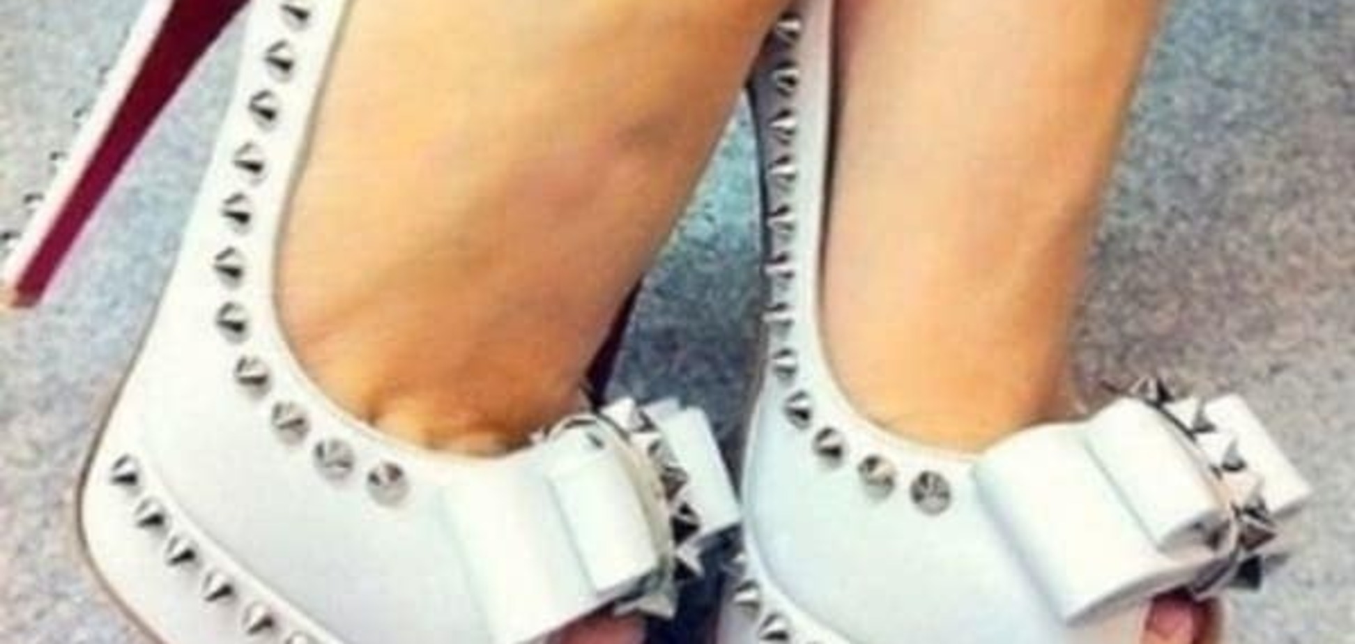 Когтистые пальцы как одно из последствий ношения  обуви на каблуках