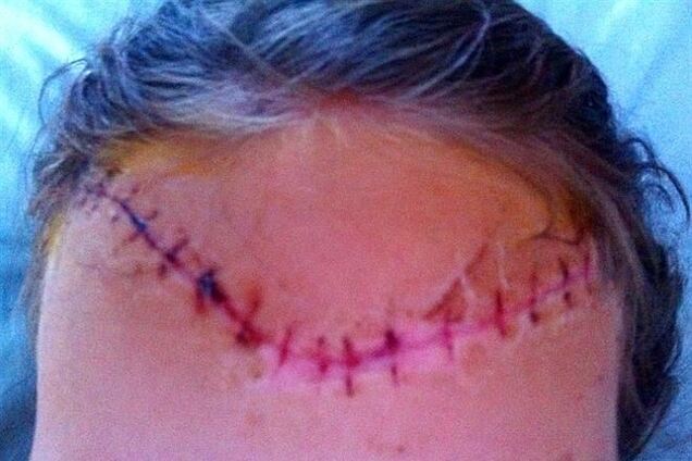 Дирекція табору виплатила дівчинці зі знятим скальпом всього 10 тис. гривень