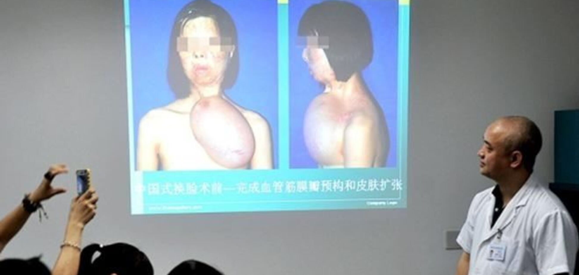 В Китае медики вырастили на груди 17-летней девушки лицо