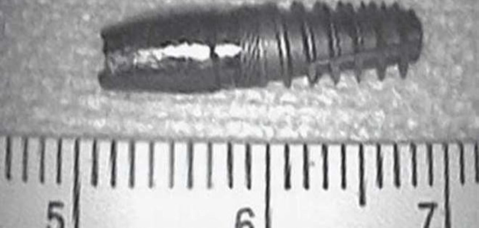 Врачи извлекли зуб из носа пациентки