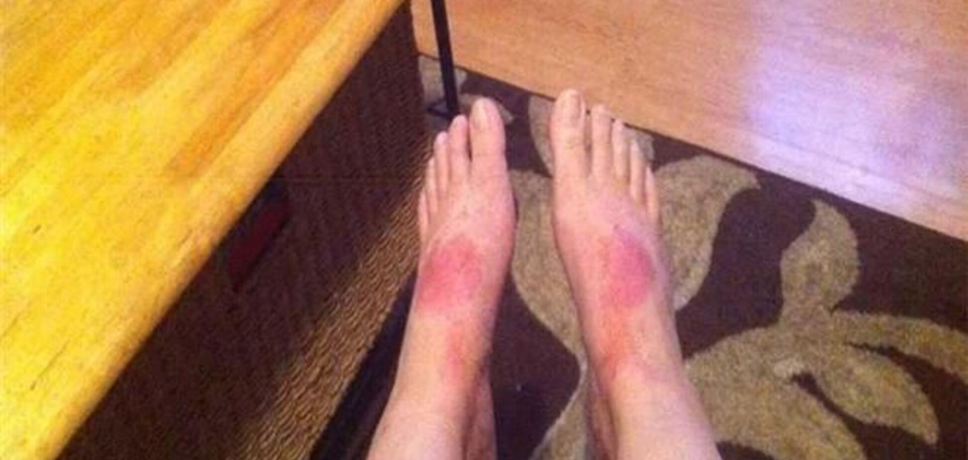 Жінка 20 років не ходила на роботу через алергію на взуття