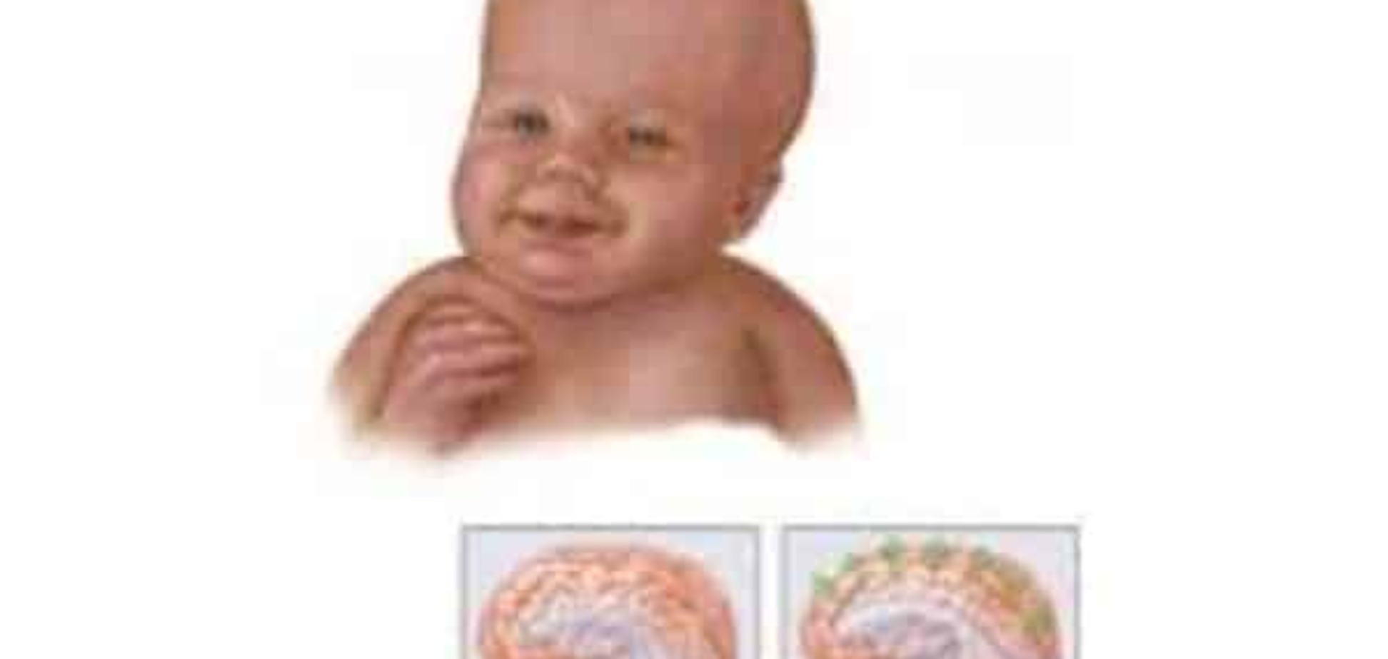Гидроцефалия  головного мозга у новорожденных