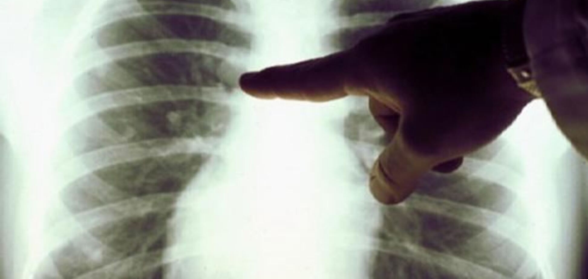 В Китае ребенок заболел раком легких из-за смога 