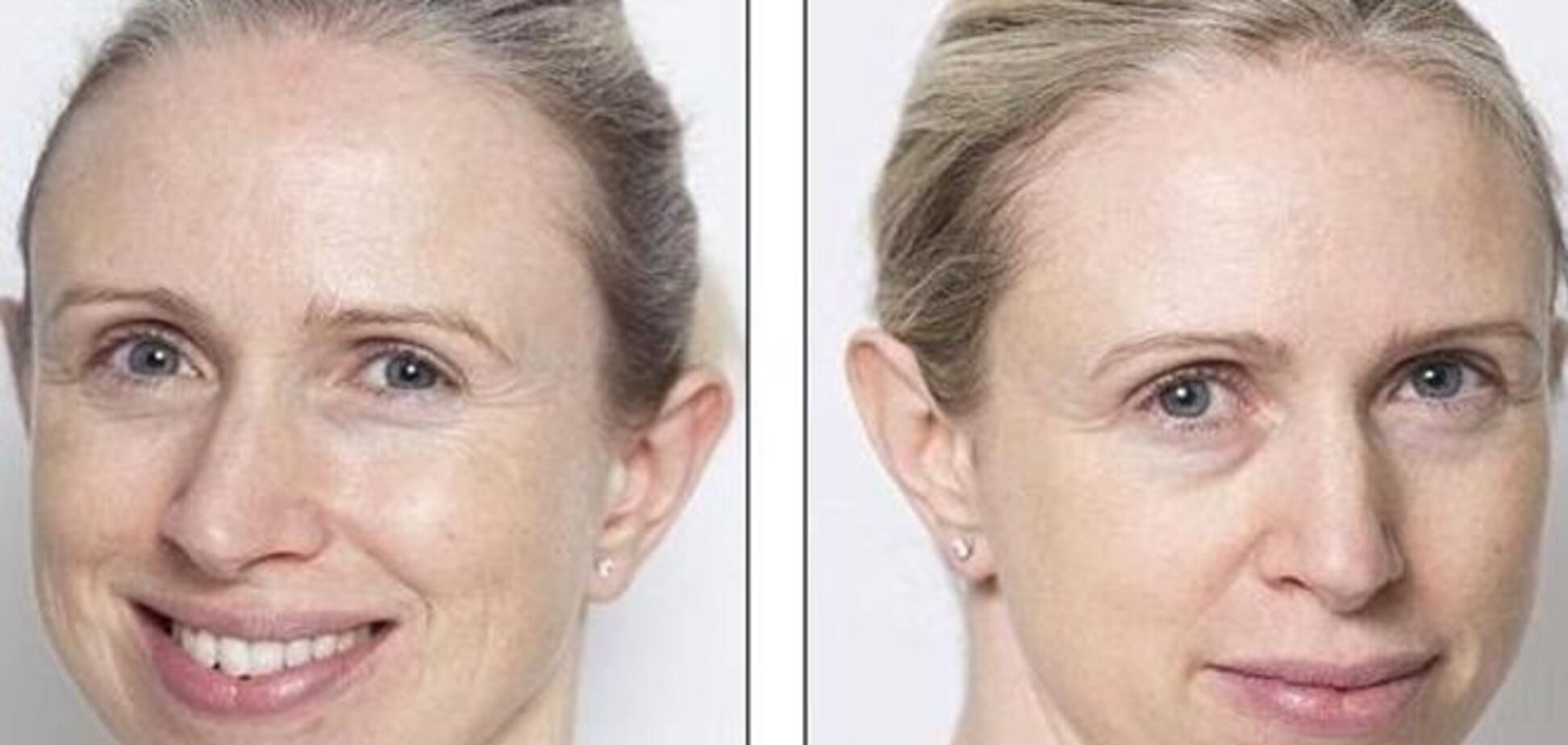 Маска из рыбьего жира помогла женщине помолодеть на 5 лет