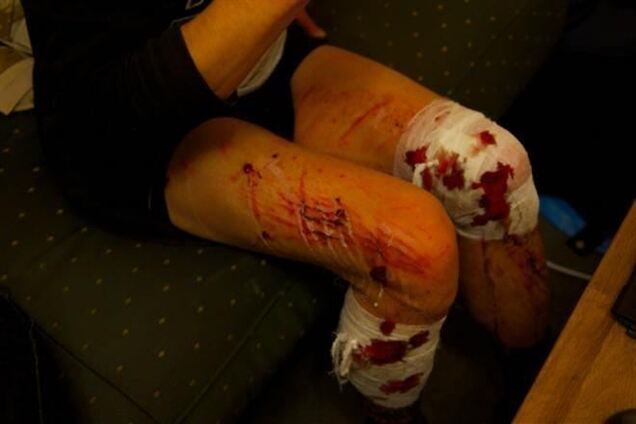 От столкновений с 'Беркутом' пострадали более 300 евромайдановцев