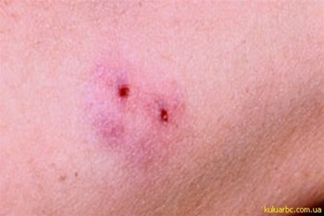 В Івано-Франківській області чоловіка вкусила змія