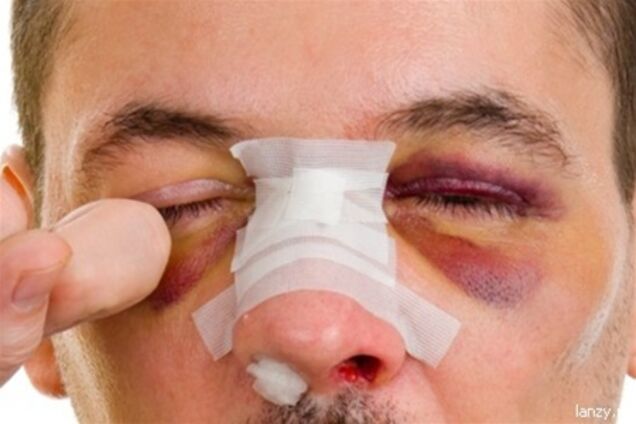 На Сумщине мужчина отсидит 5 лет за то, что откусил нос другу